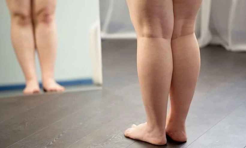 O que é lipedema, inflamação que se confunde com celulite e causa dor - lipohelp.com/Reprodução 