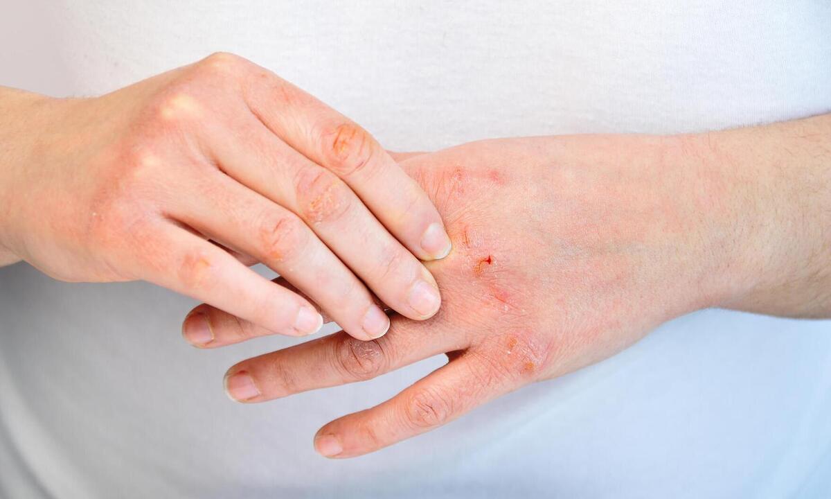 Fique alerta: produtos de limpeza podem causar dermatites de contato - PartMed/Reprodução