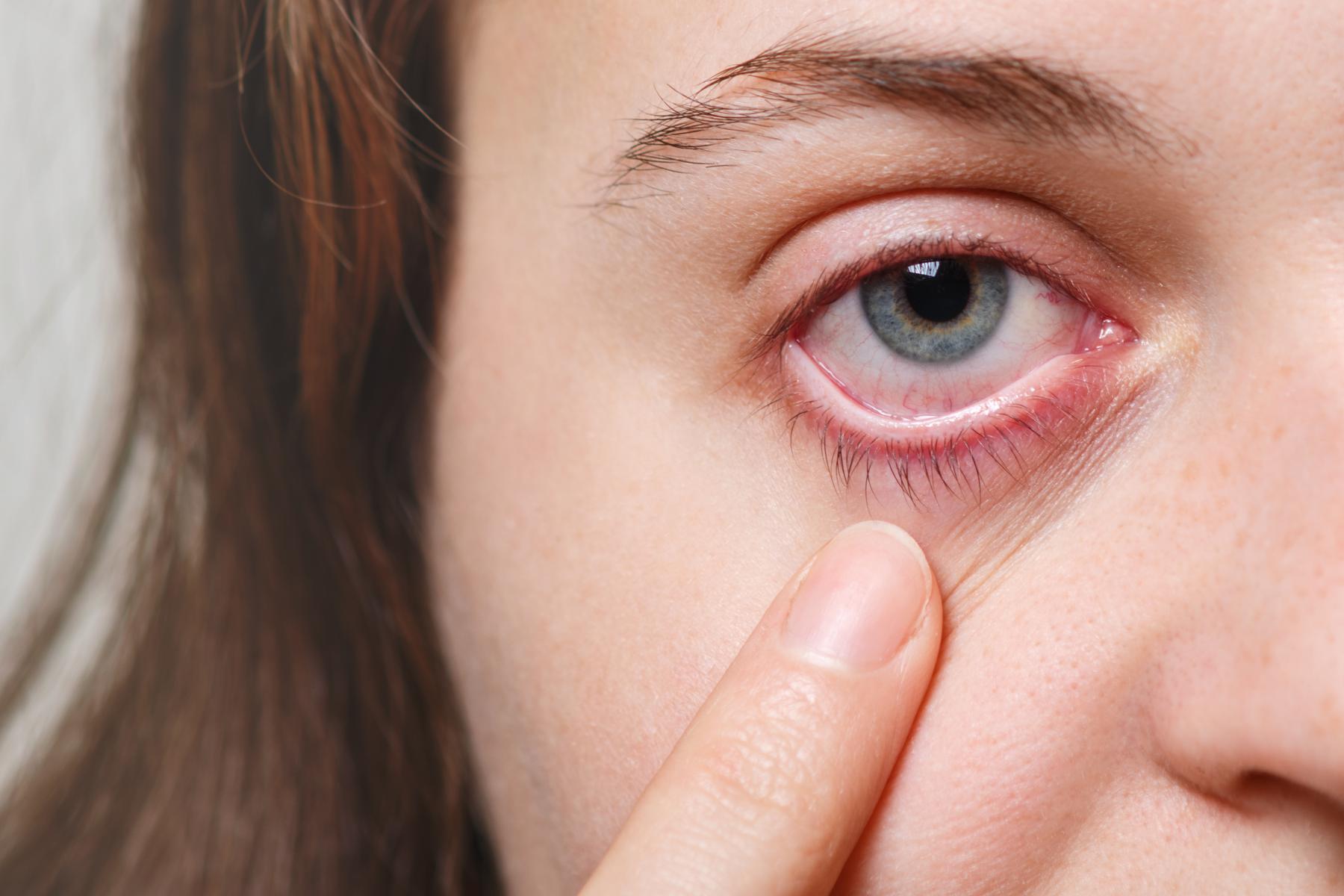 Entenda como surge o herpes ocular - Freepik