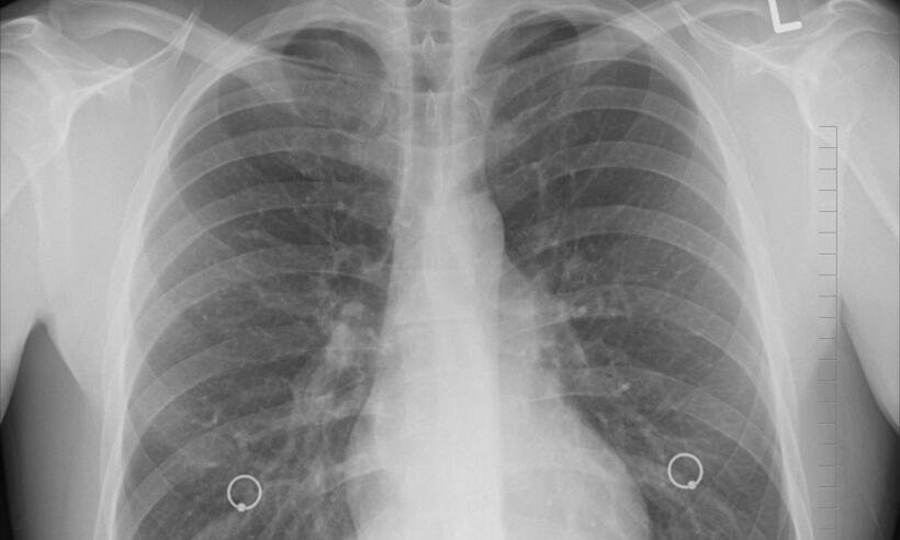 Dia Mundial da Tuberculose: redes de tratamento precisam de investimentos -  oracast/Pixabay