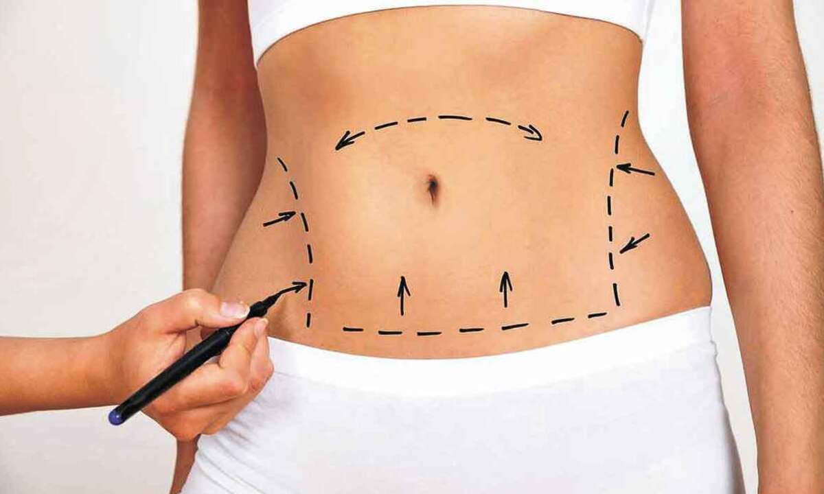 Veja como remodelar o corpo por meio da transferência de gordura - Pixabay/reprodução