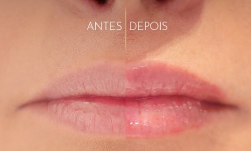 Pump lips: descubra o procedimento que turbina os lábios das famosas - Reprodução/Divulgação
