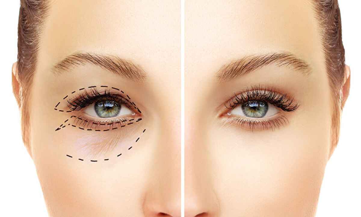 Veja os benefícios da blefaroplastia, a cirurgia plástica das pálpebras - SBCPO/reprodução
