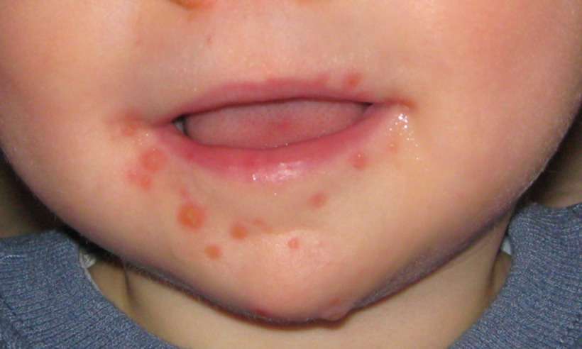 Você conhece a doença mão-pé-boca? Entenda e saiba como evitar contágio - MidgleyDJ (talk)/Wikimedia Commons 
