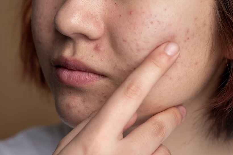 Cinco dicas que podem ajudar a tratar as espinhas - Freepik