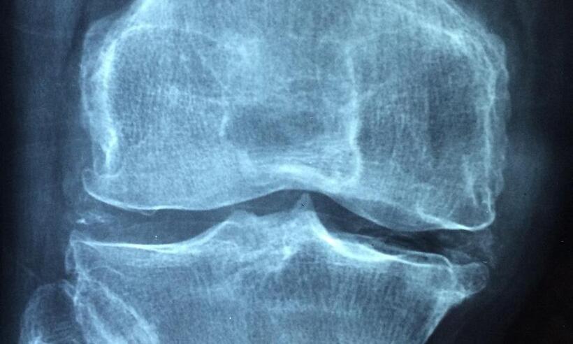 Não deixe a osteoporose te pegar de surpresa: tenha diagnóstico precoce -  Dr. Manuel González Reyes/Pixabay