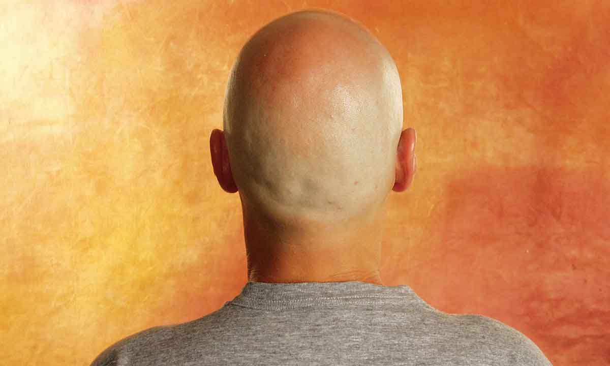Terapias hormonais podem levar homens a perder cabelo - Roberto Rocha/RR