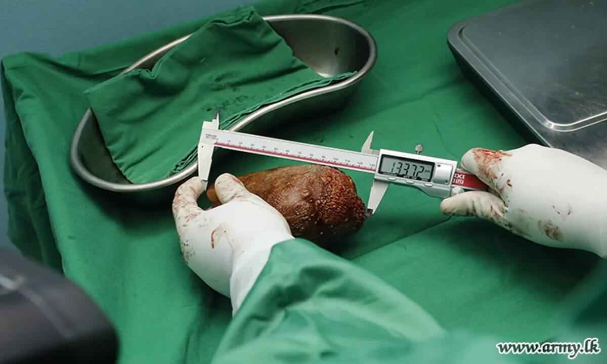 Paciente com maior pedra renal do mundo é operado no Sri-Lanka - Sri-Lanka Army/Divulgação