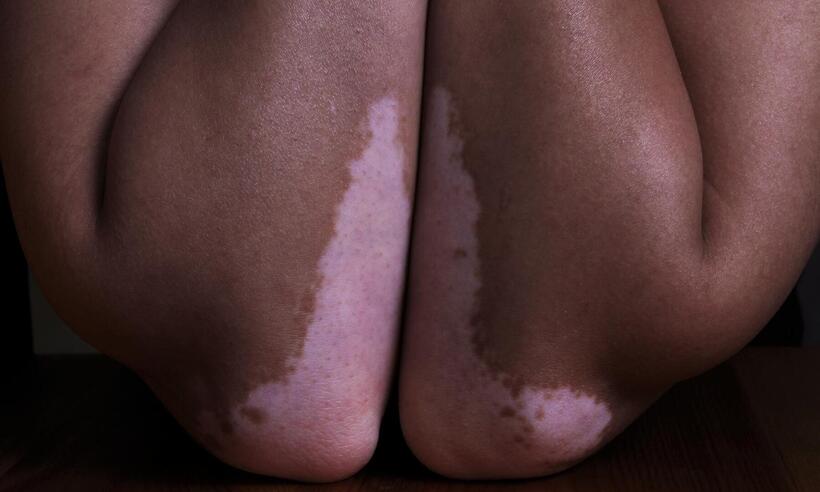 Dia Mundial do Vitiligo: doença não tem cura, mas tem tratamento -  Hanen BOUBAHRI/Unsplash
