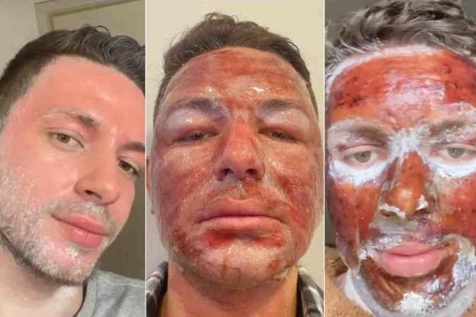 Peeling fenol: tratamento que assusta pelo resultado provocado na pele - Reprodução/Tik Tok