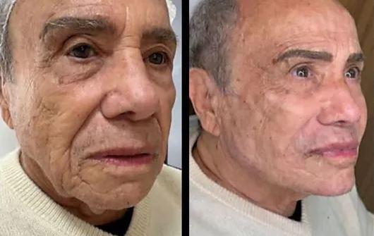 Mulher de Stênio Garcia diz que infecção não tem relação com harmonização facial - Divulgação