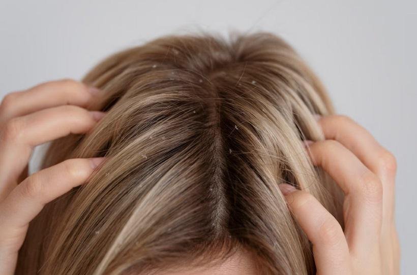 Pessoas com caspa podem ou não lavar o cabelo todos os dias? - Freepik