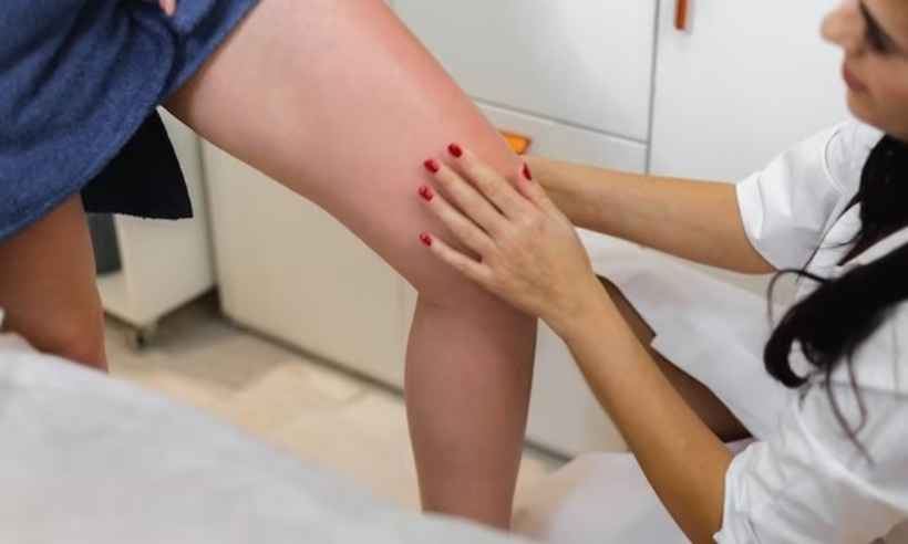 Insuficiência venosa crônica: a doença que acomete mais mulheres que homens - Freepik   