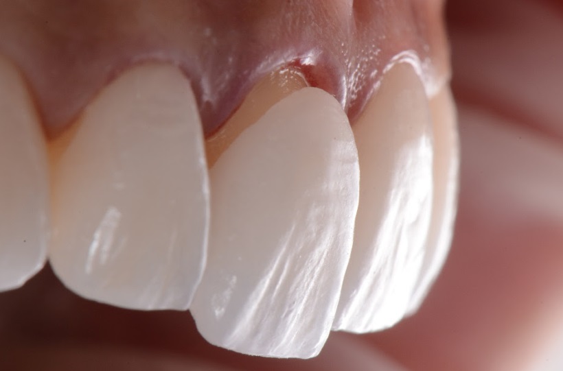 Lentes e facetas dentárias: indicações e vantagens - Divulgação/Oral Sin