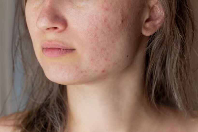 Acne: usar colírio para suavizar espinhas pode dar alergia e irritar a pele - Freepik