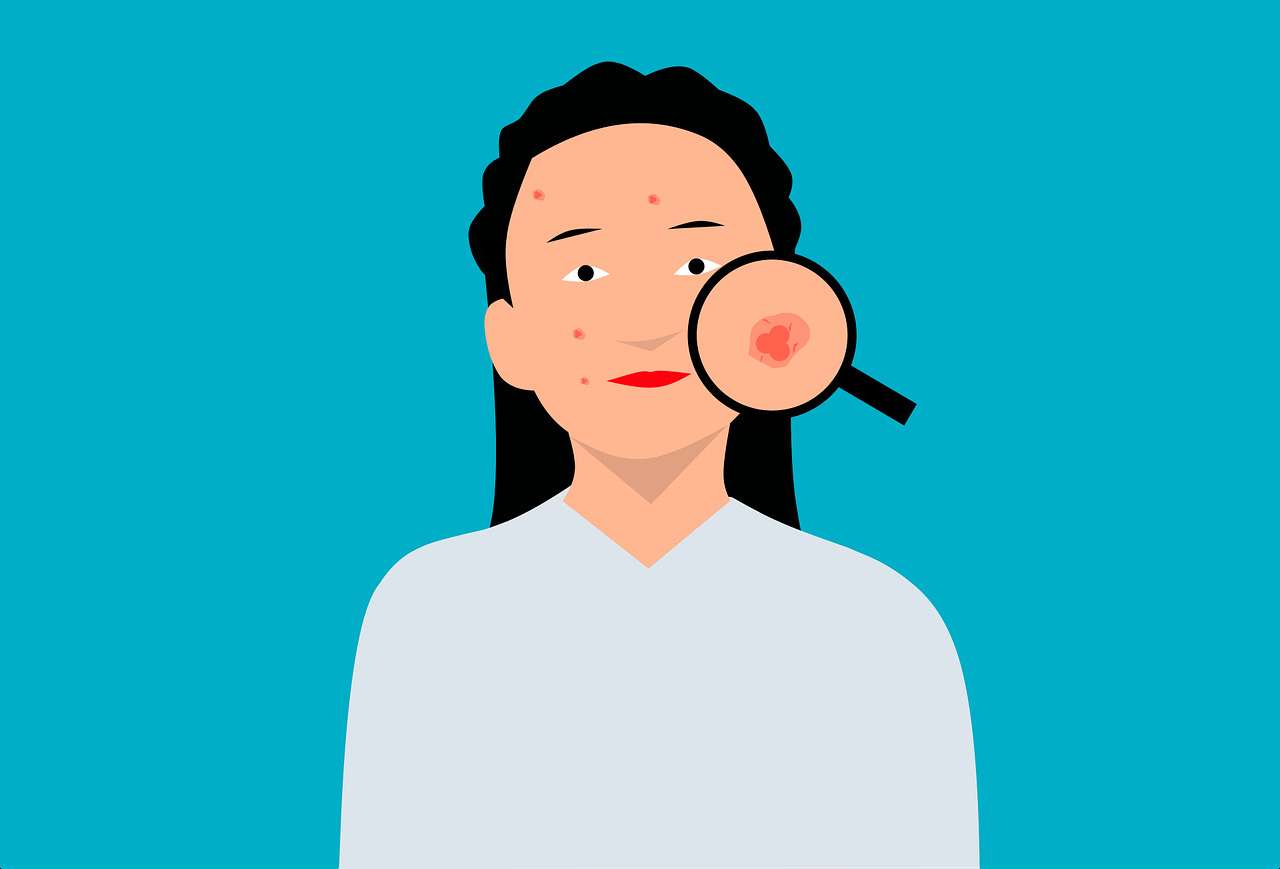 Acne malcuidada pode causar graves problemas de saúde - Pixabay