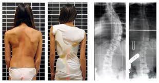 Escoliose em crianças e adolescentes? Especialista alerta para tratamentos - Wikimedia Commons