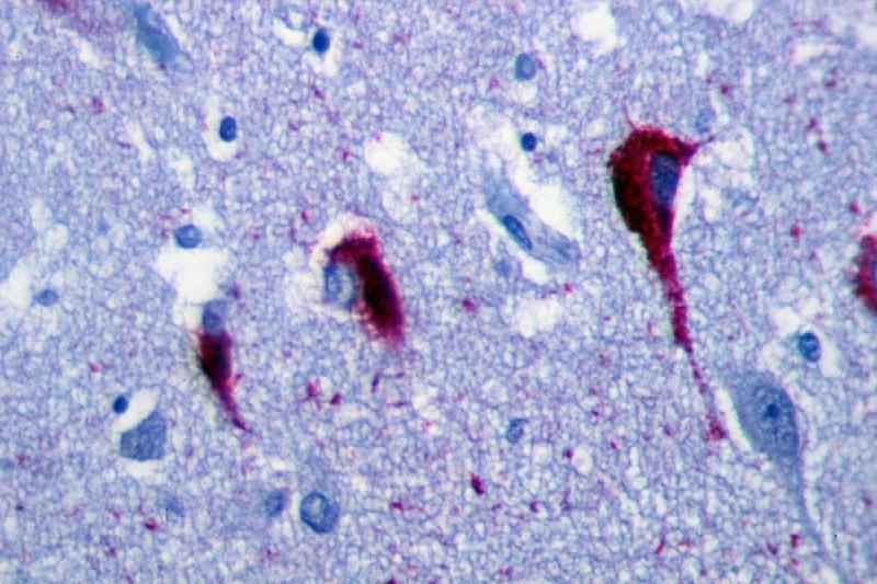 Cientistas descobrem proteína que pode ajudar a prevenir o Alzheimer - (Wikemedia Commons/Divulgação)