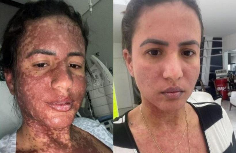 Dermatologista explica síndrome rara que acomete a mulher de Frank Aguiar - Reprodução