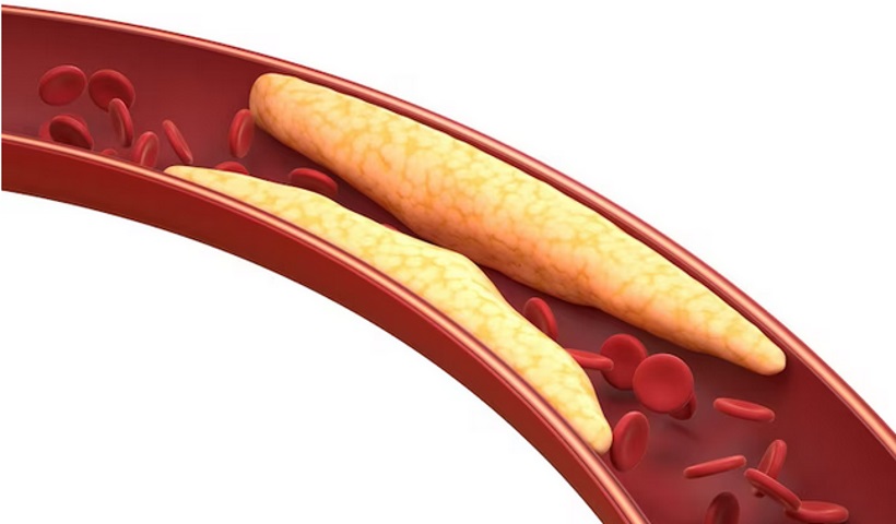 Colesterol VLDL, LDL e HDL: qual a diferença? 