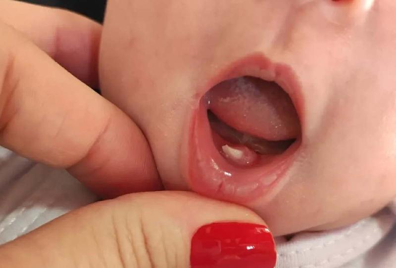 Caso raro: o bebê que nasceu com dente; saiba por que - (Reprodução redes sociais)