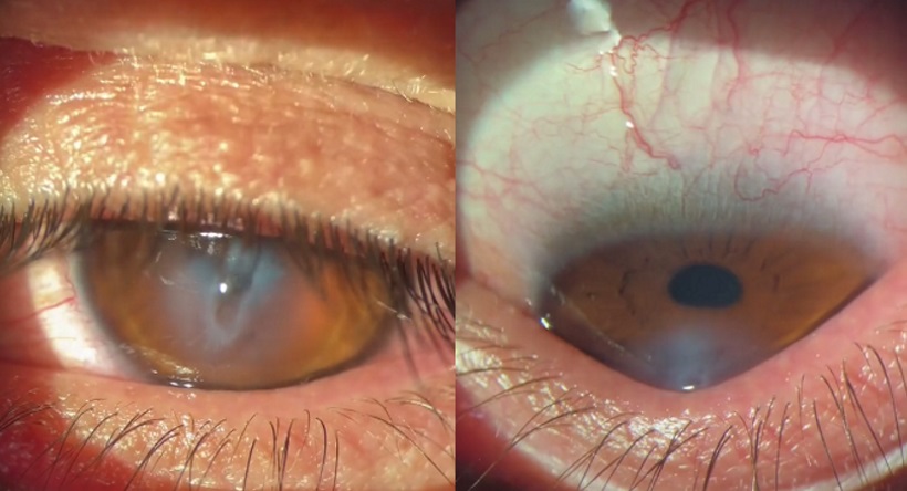 Coçar os olhos: jovem perde visão e precisará de transplante de córnea  - Reprodução/TikTok
