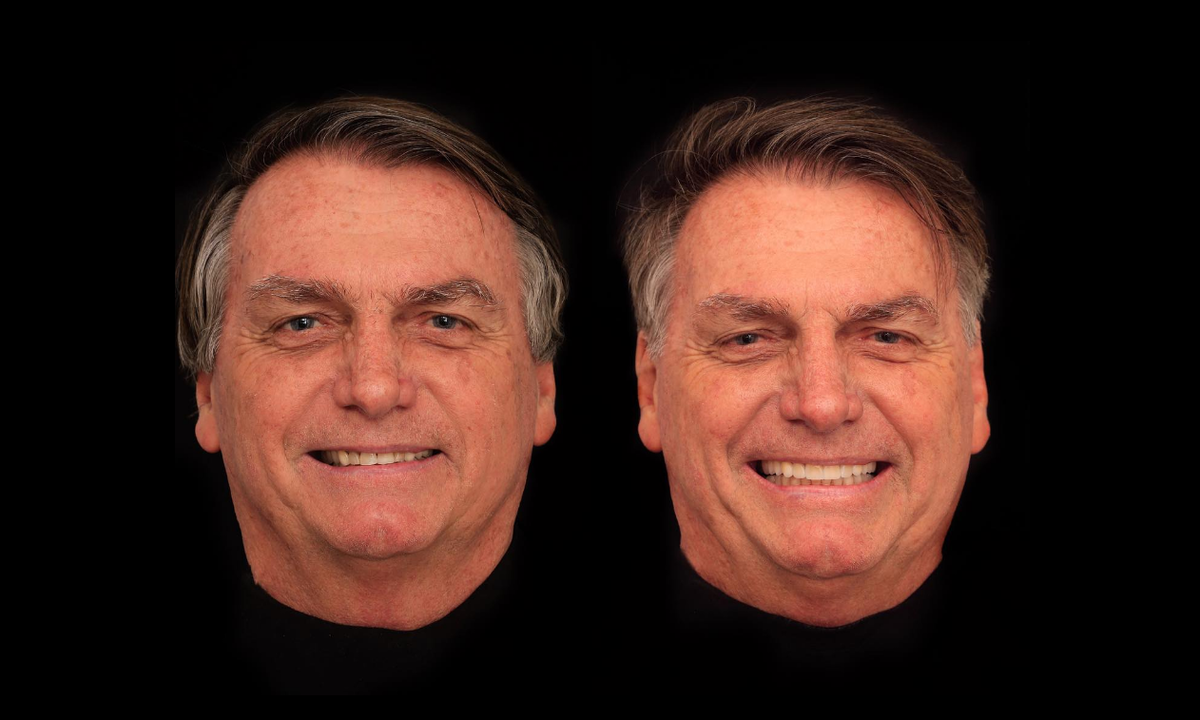 Bolsonaro gasta R$ 84 mil em harmonização facial e dentária  - Divulgação