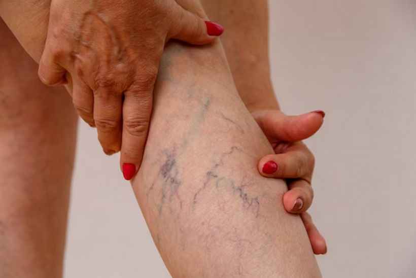 Vasinhos na perna podem sinalizar problemas mais graves de circulação - Freepik