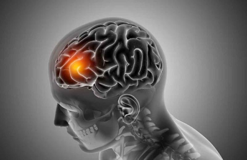 Como saber se está com um aneurisma cerebral? Confira os sintomas - (Reprodução/ Freepik/ Kjpargeter)