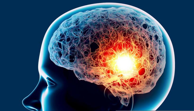 Aneurisma cerebral: condição de saúde pode ter consequências devastadoras - Naeblys/iStock
