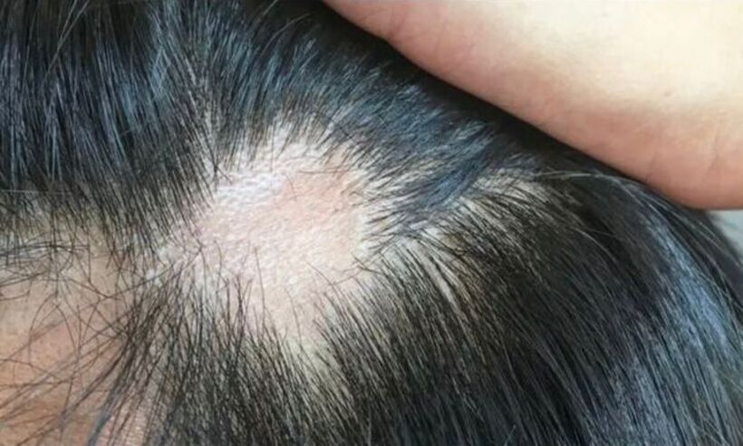 Astenia primaveril: quando a queda de cabelo é causada pela primavera  - Redação MXP/ Divulgação