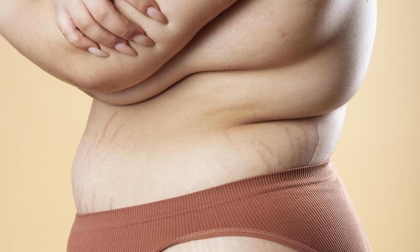 Conheça a doença que causa deformação corporal e é confundida com obesidade - Freepik 