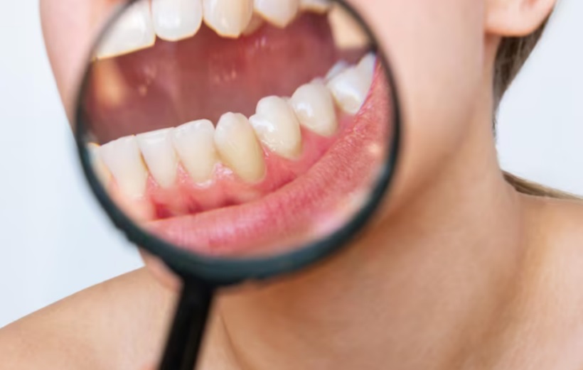 Hiperdontia: entenda condição que causa desenvolvimento de dentes extras - Freepik