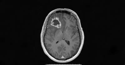 Câncer no cérebro: vírus modificado age contra a doença - Gerard Toussaint, Texas A&M Health Science Center