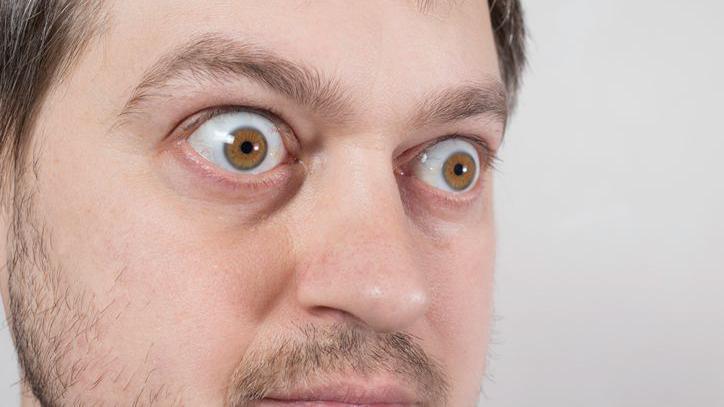 A doença na tireoide que faz os olhos saltarem do rosto - Getty Images