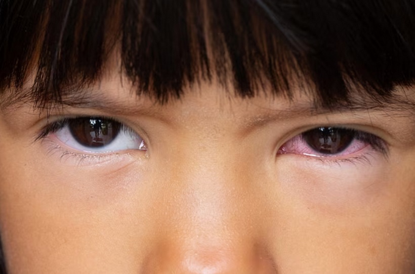 Olhos irritados? O que é a conjuntivite primaveril e como se prevenir